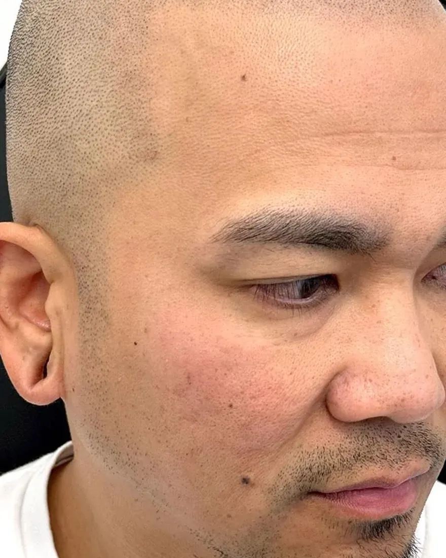 Buzz-cut scalp micropigmentation hairline result