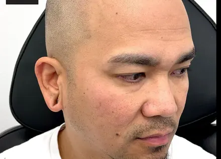 Healed scalp micropigmentation hairline by Pigment2Scalp, San Diego