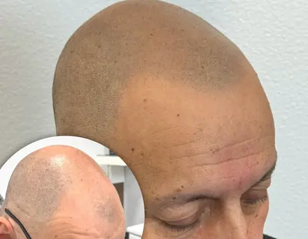 Healed SMP result, San Diego by Pigment2Scalp, San Diego