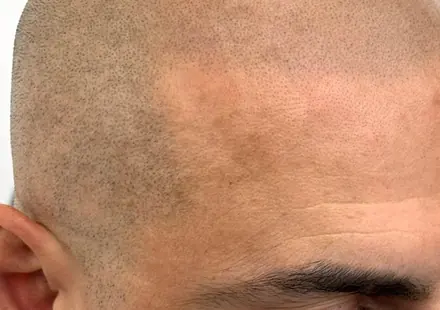 Healed buzz-cut SMP by Pigment2Scalp, San Diego