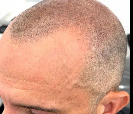 Density fill through a thinning scalp by Pigment2Scalp, San Diego