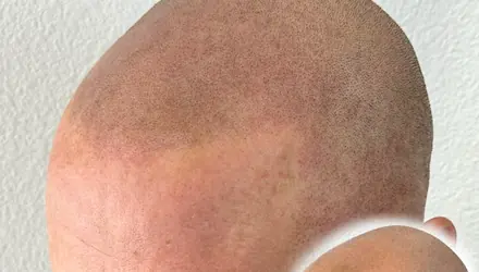 Healed SMP hairline by Pigment2Scalp, San Diego
