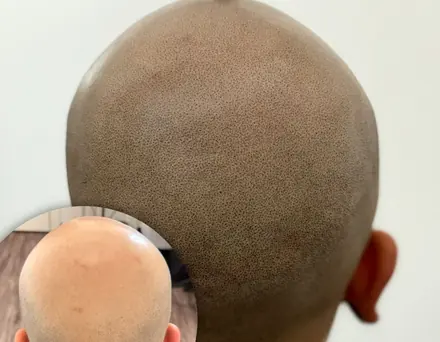 Scalp micropigmentation crown result by Pigment2Scalp, San Diego