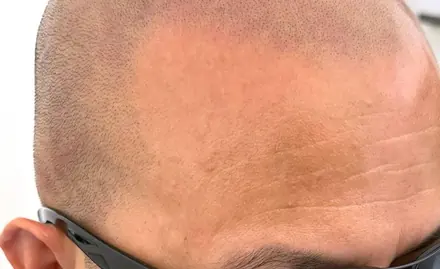 Healed SMP, side profile by Pigment2Scalp, San Diego
