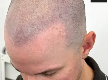 Healed SMP result by Pigment2Scalp, San Diego