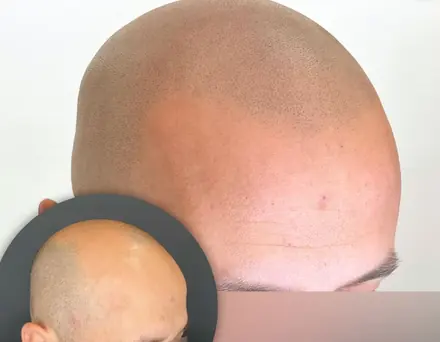 Healed scalp micropigmentation for male pattern hair loss by Pigment2Scalp, San Diego