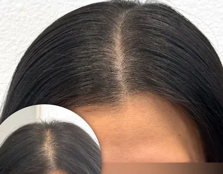 Density fill result by Pigment2Scalp, San Diego