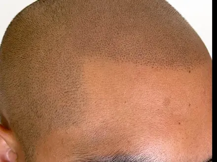 SMP hairline, healed by Pigment2Scalp, San Diego