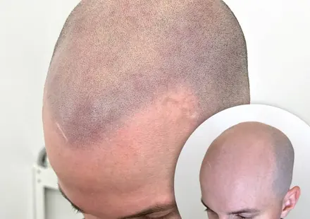 Healed scalp micropigmentation by Pigment2Scalp, San Diego